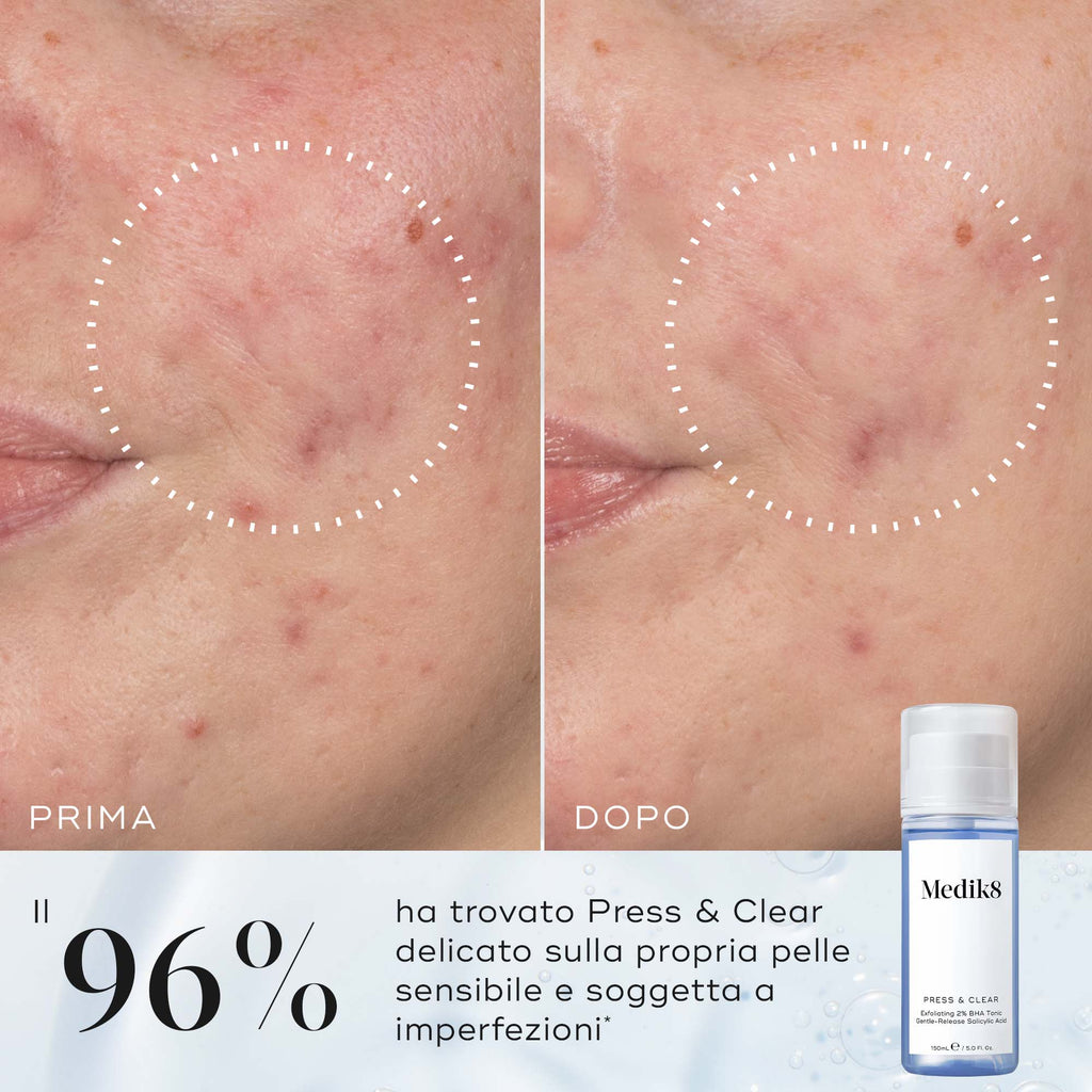 Confronto prima e dopo della guancia di una partecipante nel tempo, accanto a un flacone Medik8 Press & Clear. Il testo in italiano evidenzia che il 96% ha trovato Press & Clear delicato sulla propria pelle sensibile e soggetta a imperfezioni.